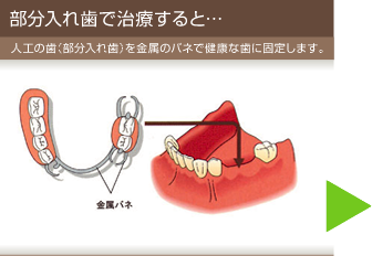 部分入れ歯で治療すると…　人工の歯（部分入れ歯）を金属のバネで健康な歯に固定します。