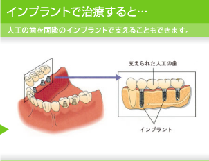 インプラントで治療すると…　人工の歯を両隣のインプラントで支えることもできます。